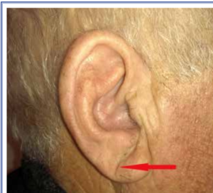 earlobe-crease-heart-disease