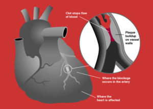 ear-lobe-crease-heart-disease-risk